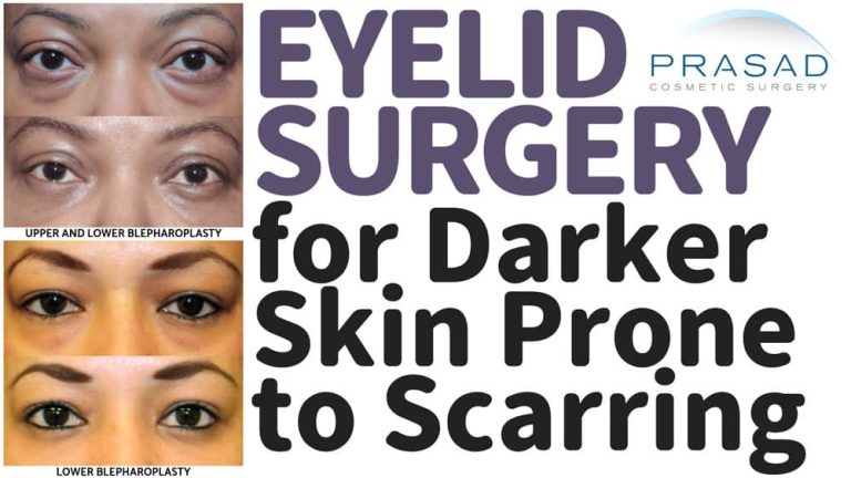 eyelid surgery for darker skin prone to scarring before and after photos