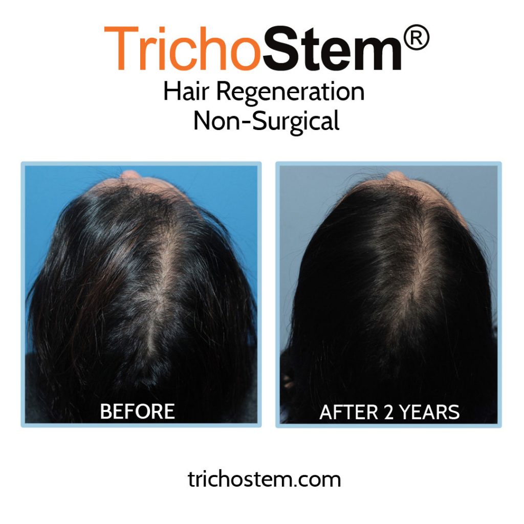 female hair thinning before and after 2 years results of TrichoStem Hair Regeneration