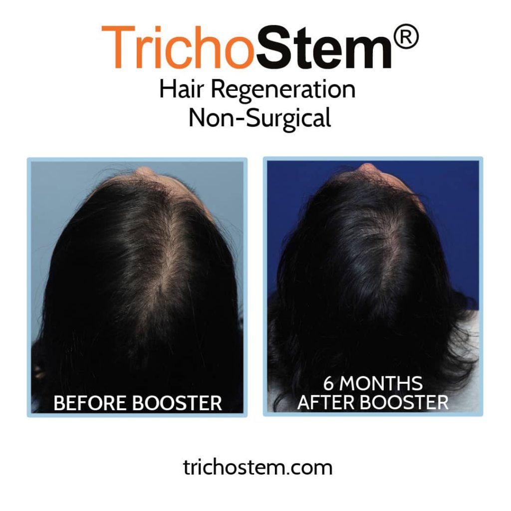 female pattern hair loss before and after booster of TrichoStem Hair Regeneration by Dr Amiya Prasad