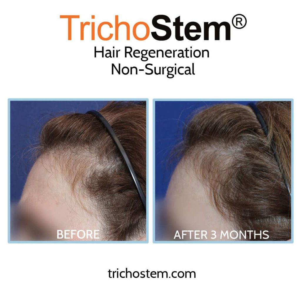 female pattern baldness on temple before and after hair regeneration treatment
