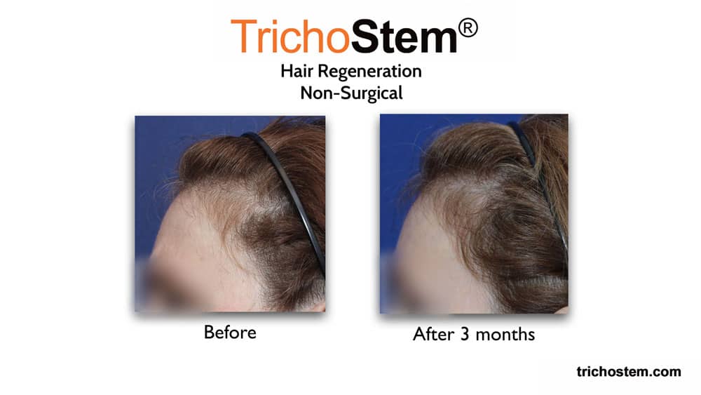 female pattern baldness treatment before and after 3 months results