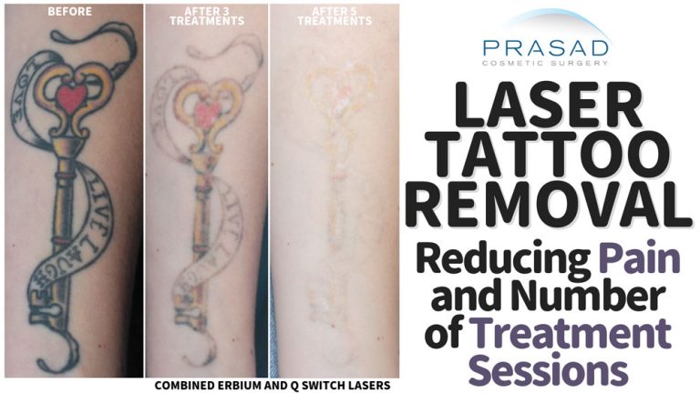 laser tattoo removal before and after 5 treatments