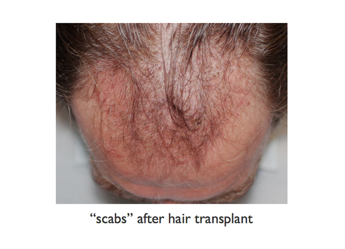 a man with scabs after hair transplant