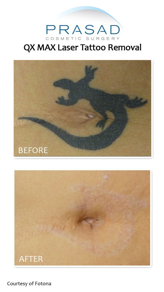 laser tattoo removal before and after at Prasad Cosmetic Surgery NYC