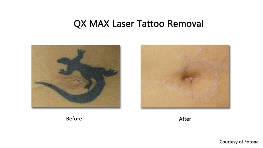 black tattoo removal before and after