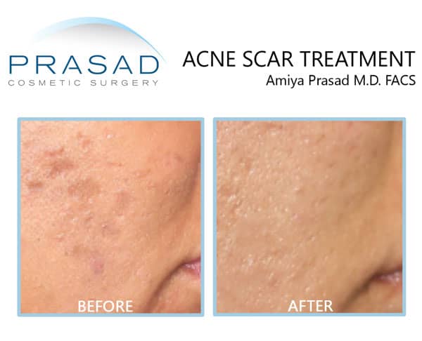 acne scar treatment before and after with collagen induction therapy through PRP