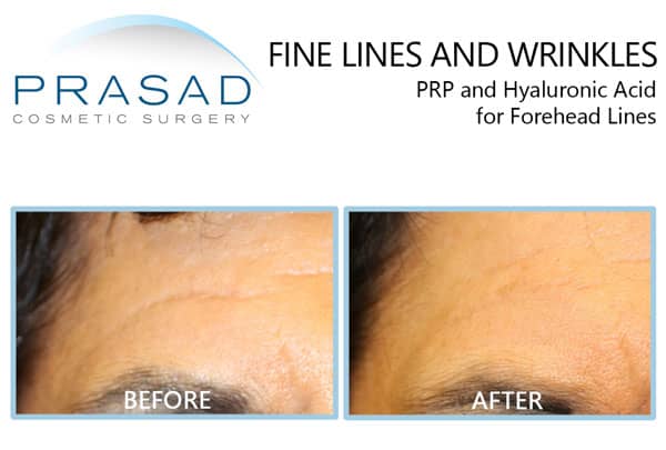 forehead line and wrinkles treatment before and after with PRP and filler