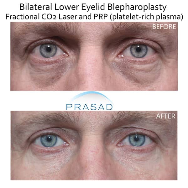 upper and lower blepharoplasty before and after with laser and PRP