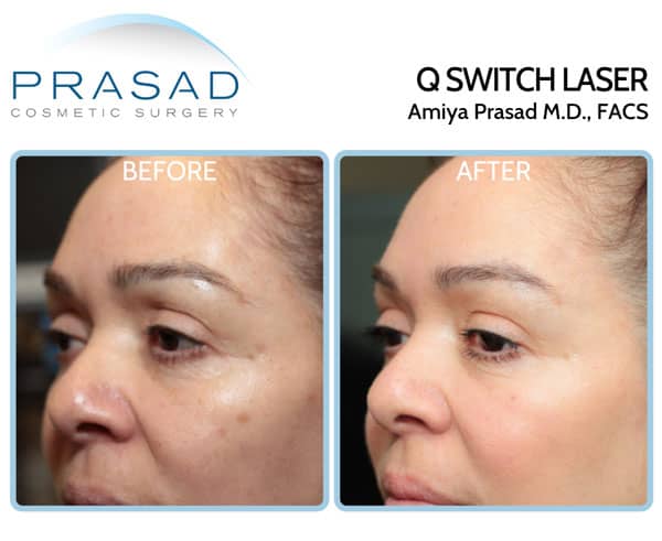 face laser treatment before and after