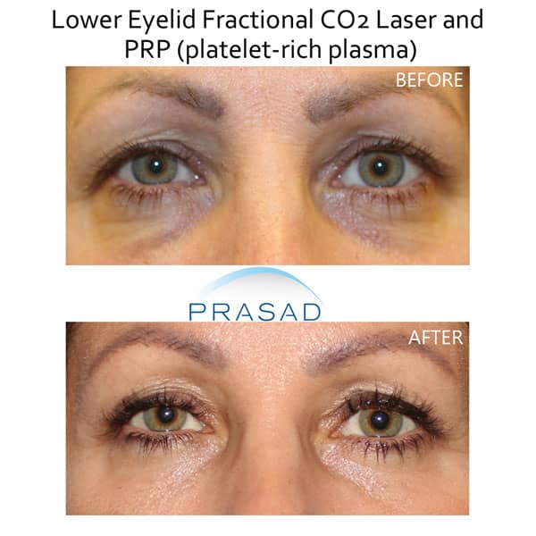 lower blepharoplasty before and after with laser and PRP treatment