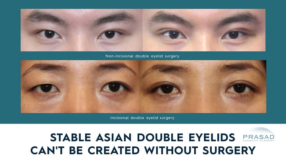 stable Asian double eyelids cant be treated without surgery