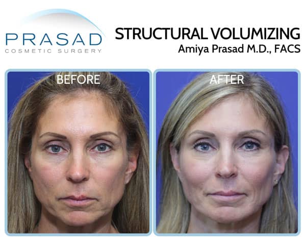 y lift before and after for facial aging treatment
