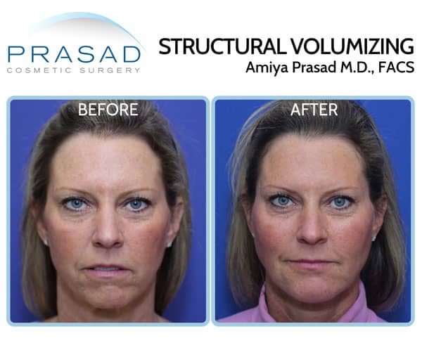 y lift before and after results on female patient in 40s