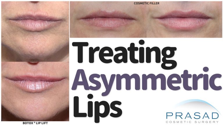 treating asymmetric lips before and after