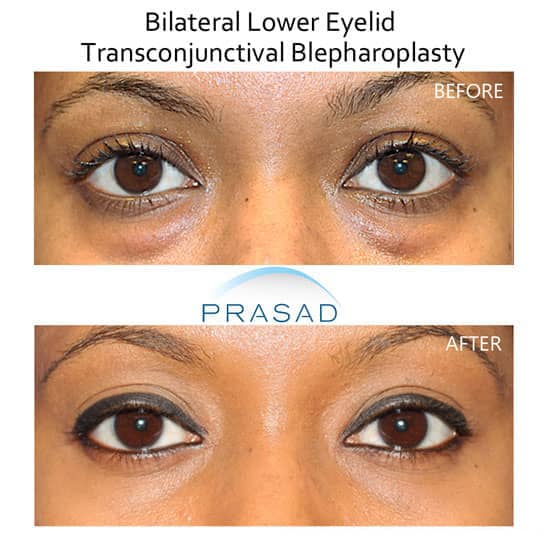 eye bag removal surgery before and after results on African-American patient
