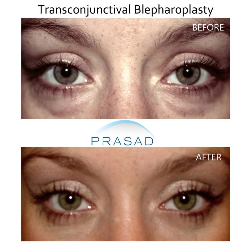 lower blepharoplasty before and after on young female patient