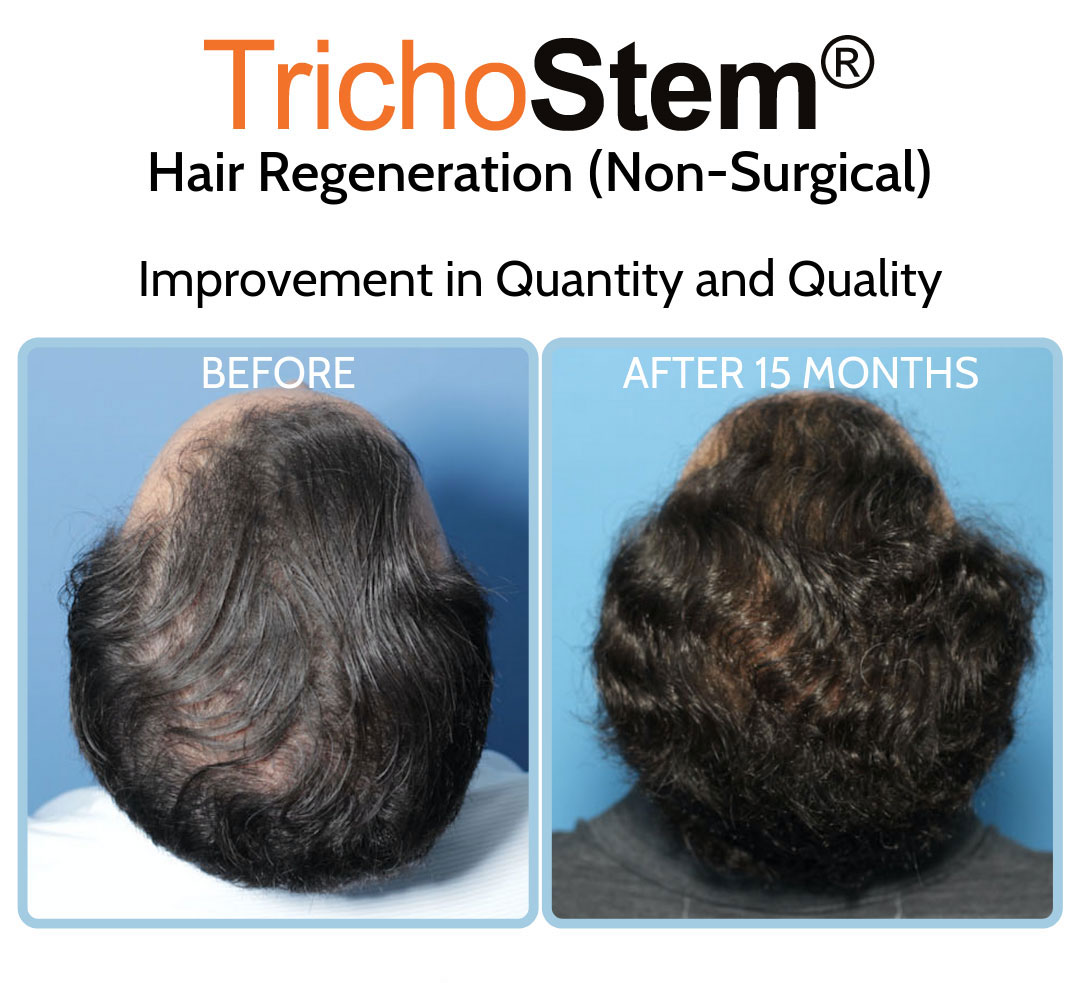 Hair Regeneration before and after treatment for hair loss on crown area