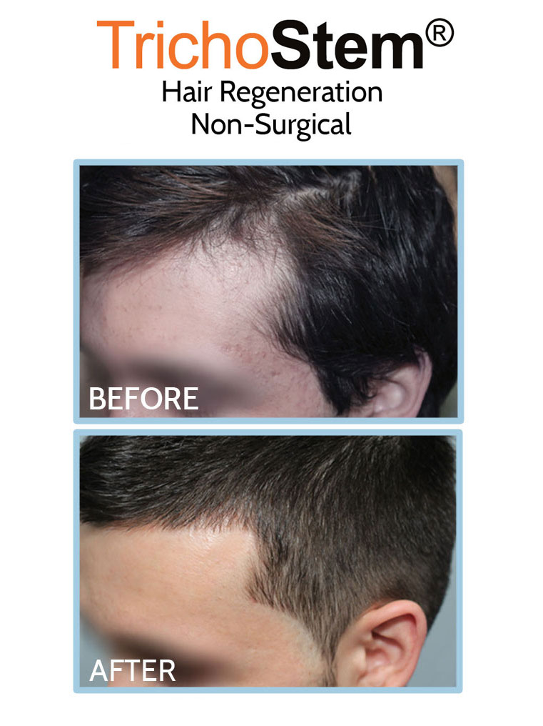 Trichostem Hair Regeneration before and after treatment results for hair loss