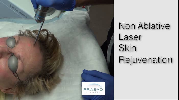 laser treatment for forehead wrinkles