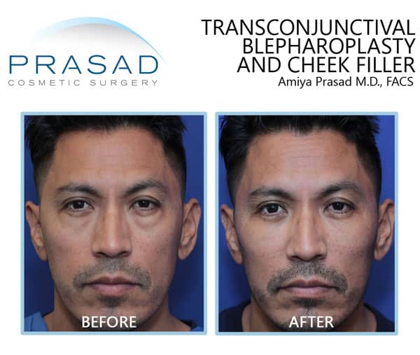under eye hollowing treatment before and after - male patient