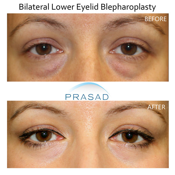 under eye bag removal surgery before and after