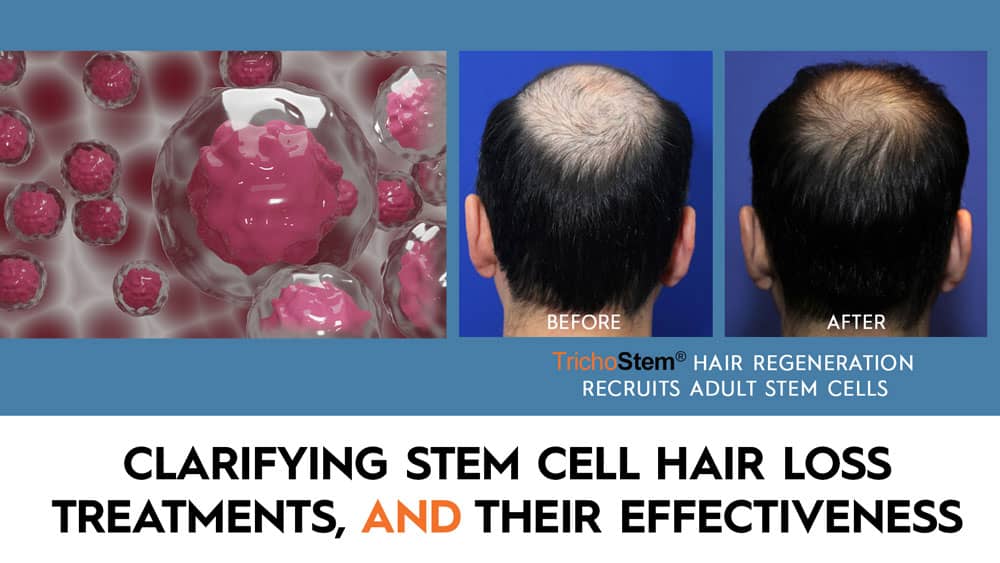 stem cells illustration and acell+PRP hair loss treatment before and after with the text Clarifying Stem Cell Hair Loss Treatments and Effectiveness