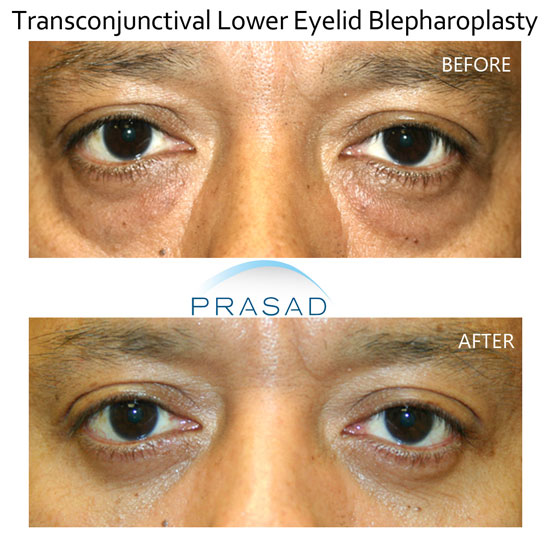 lower blepharoplasty before and after results - male patient