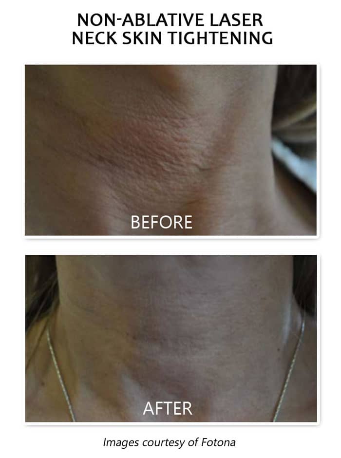laser treatment for neck wrinkles before and after results