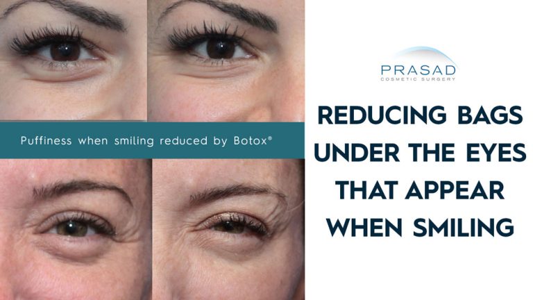 reducing bags under the eyes that appear when smiling