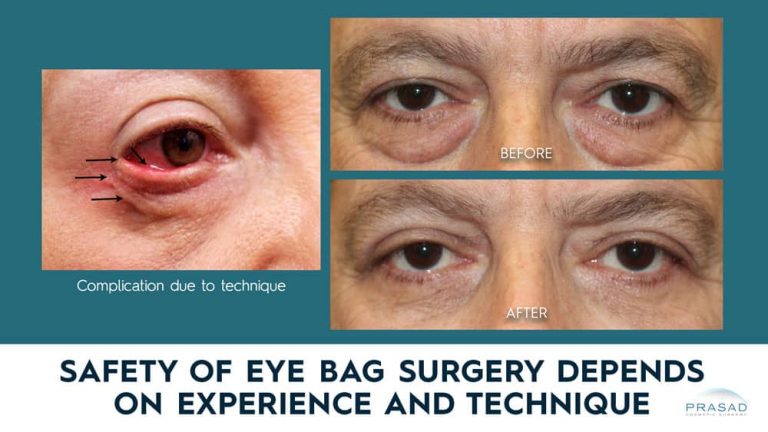 eye bag removal surgery before and after results of male patient with the text Safety of Eye Bags Surgery depends on Experience and Technique