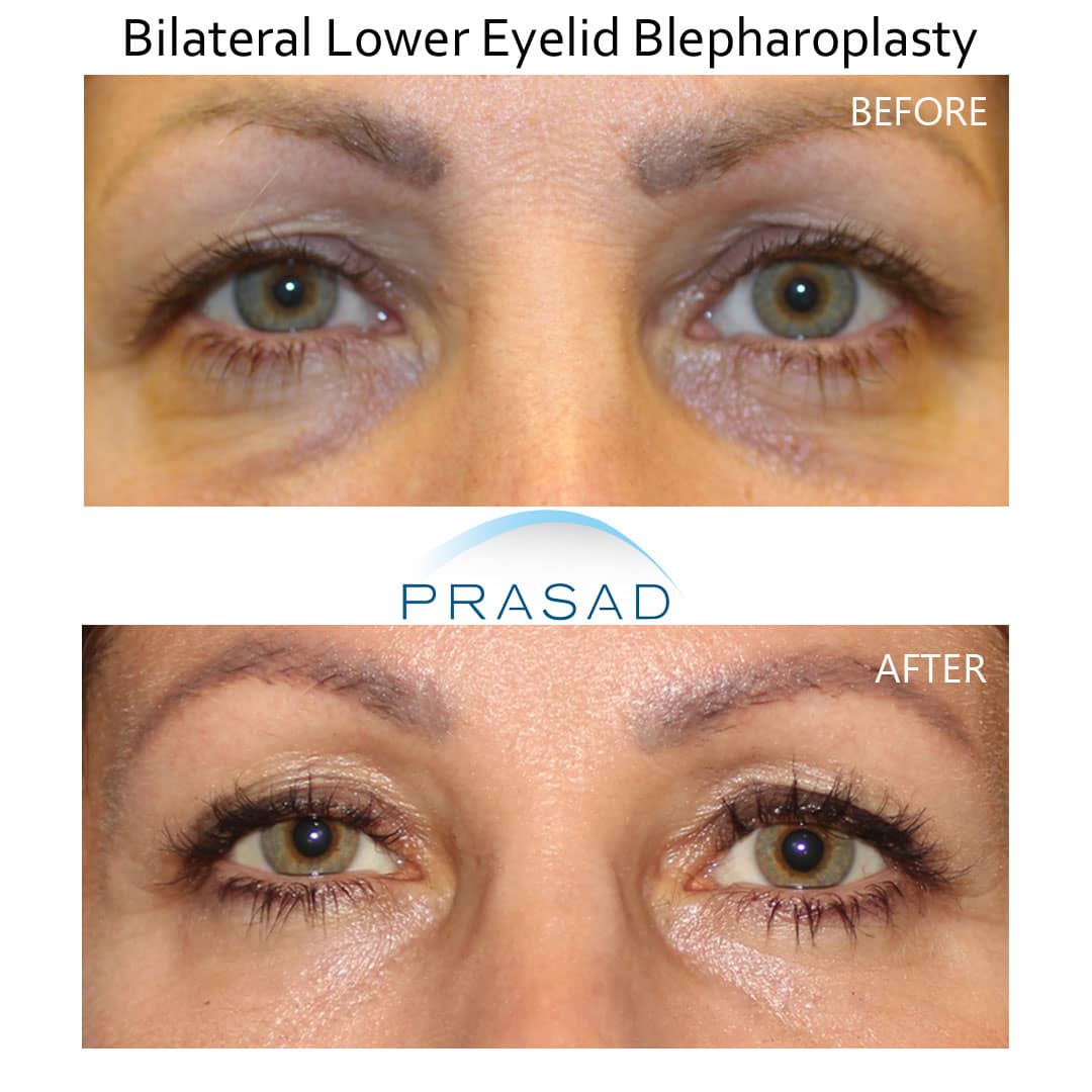 laser and lower blepharoplasty before and after results