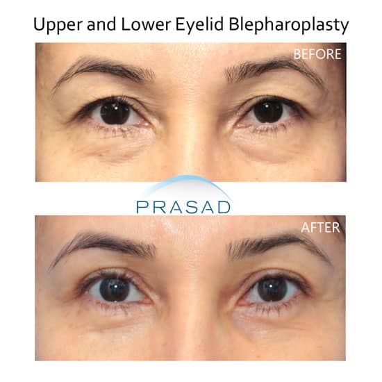 upper and lower blepharoplasty before and after results - female patient