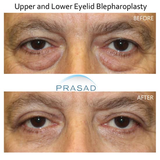 eye bag removal surgery before and after results - older male patient