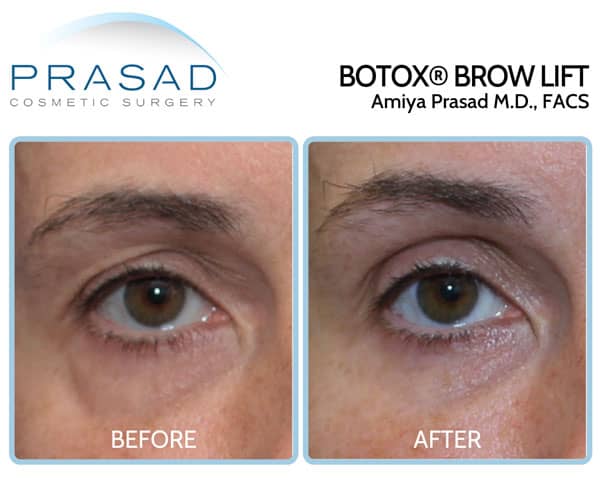 Botox for Brow lift before and after treatment at Prasad Cosmetic Surgery