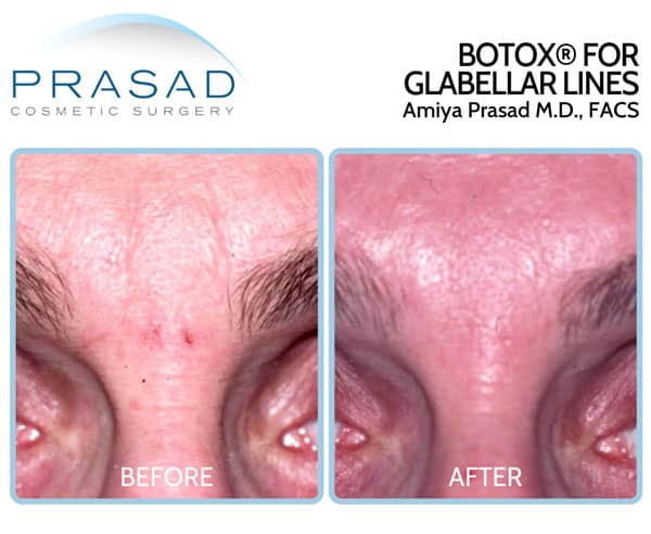 Botox for glabellar lines before and after treatment by Dr. Amiya Prasad