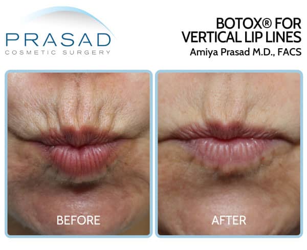 Botox for lip lines before and after treatment by Dr. Amiya Prasad