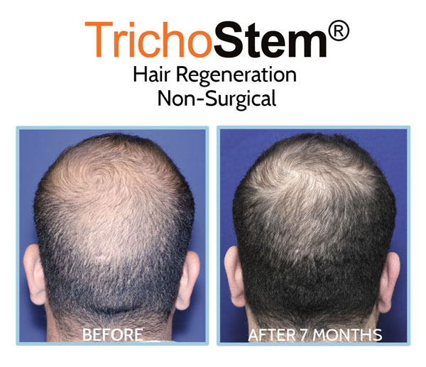 PRP+ACell before and after results of treatment for hair loss