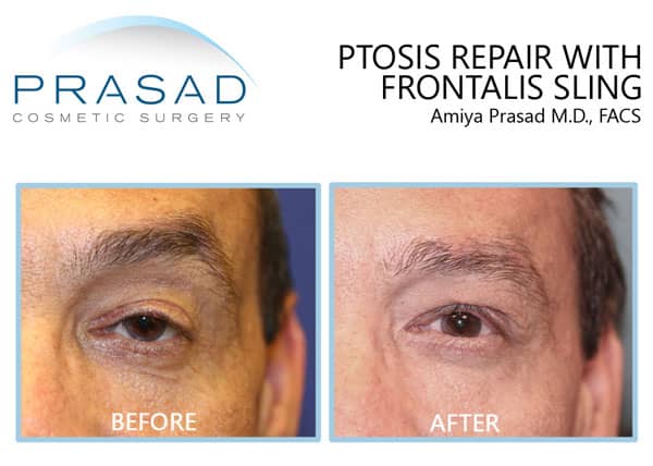 ptosis surgery before and after results. patient has ptosis with frontalis sling