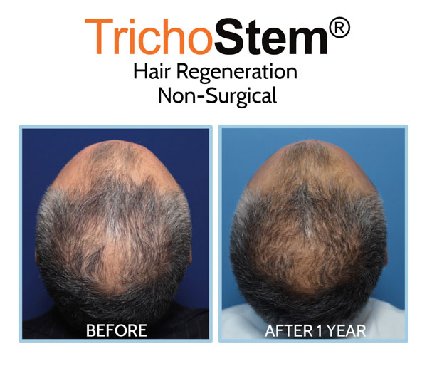 PRP ACell treatment before and after 1 year on male patient with advanced hair loss