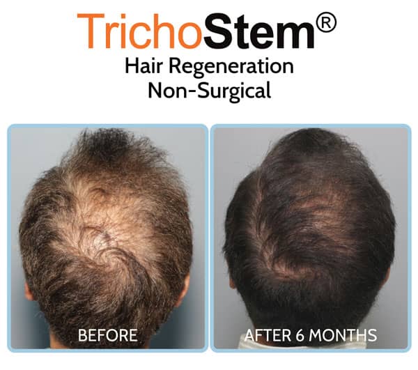 ACell + PRP treatment before and after results on male patient with advance hair loss