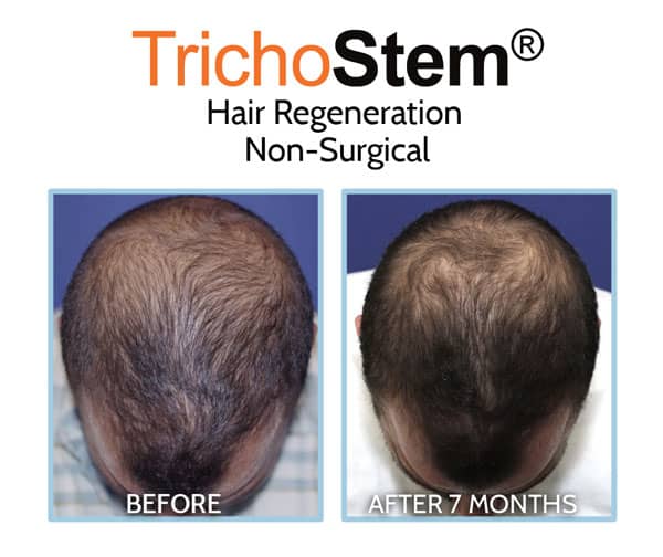 ACell PRP before and 7 months after results on male patient with advance crown hair loss