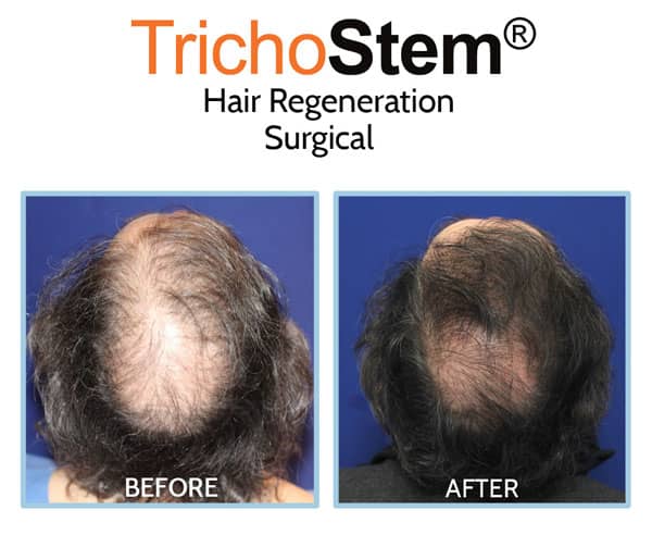 Hair transplant and PRP Acell for hair loss treatment before and after results