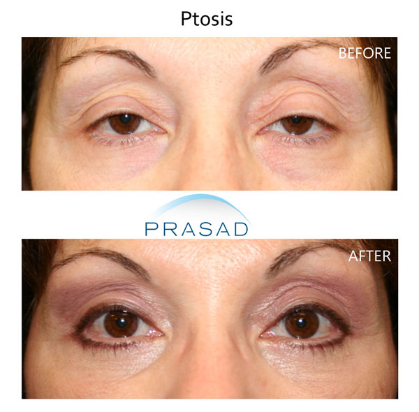 ptosis surgery before and after full recovery. Procedure performed by Dr. Amiya Prasad
