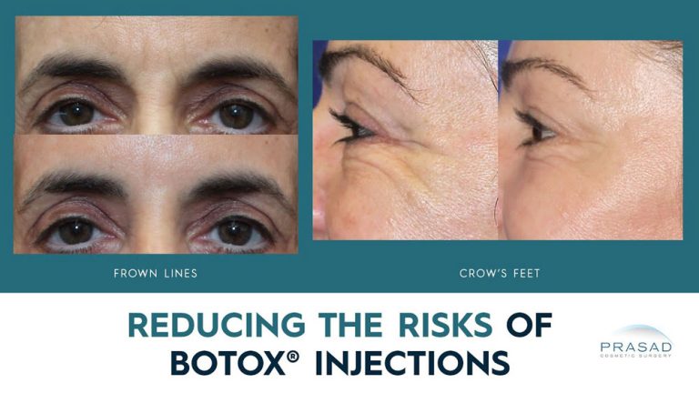 Botox before and after treatment on patient with the text Reducing the Risks of Botox Injections