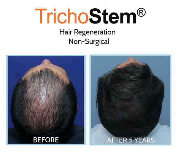 Acell PRP for hair loss before and after treatment