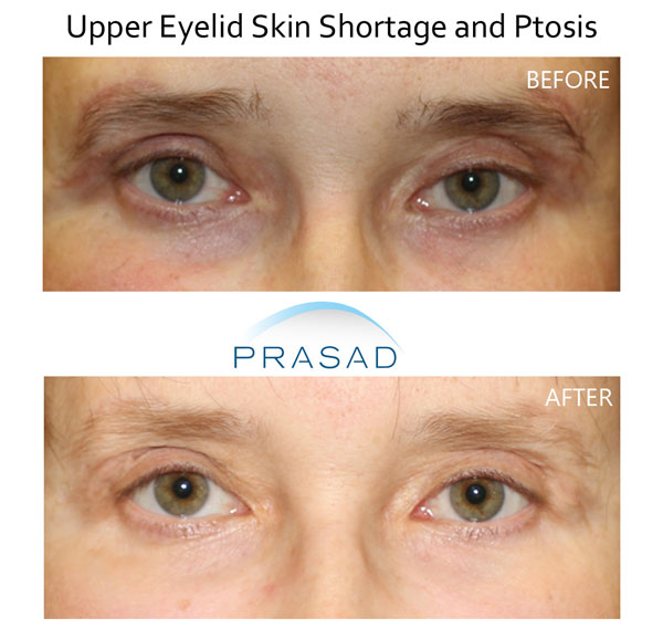 before and after upper eyelid blepharoplasty revision on patient with upper eyelid skin shortage