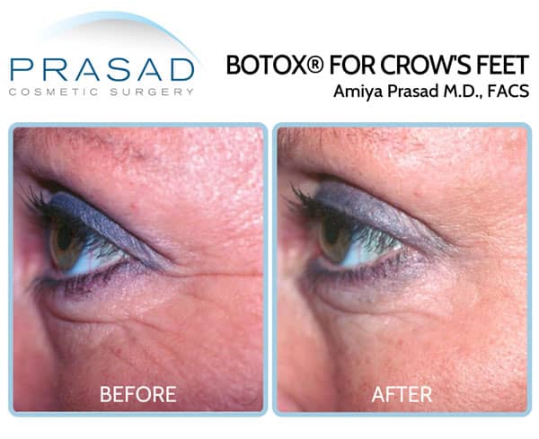 Botox treatment for crows feet before and after