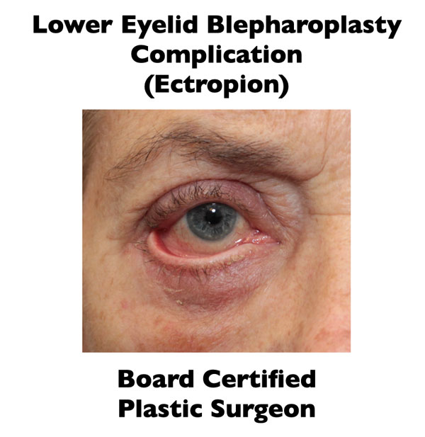 example of lower blepharoplasty complications that needs blepharoplasty revision