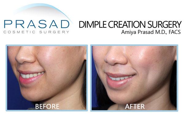 dimpleplasty before and after results on female patient