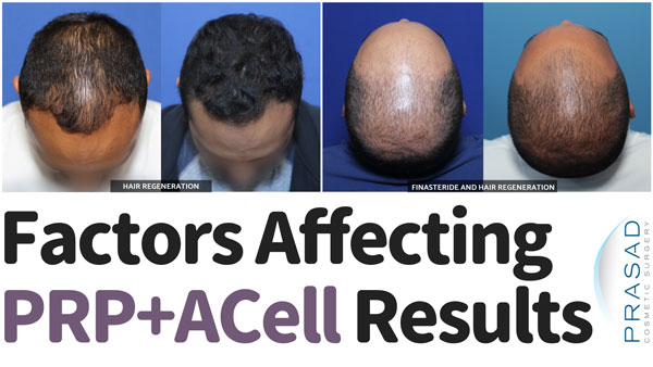 hair regeneration treatment before and after with the text factors affecting prp acell results